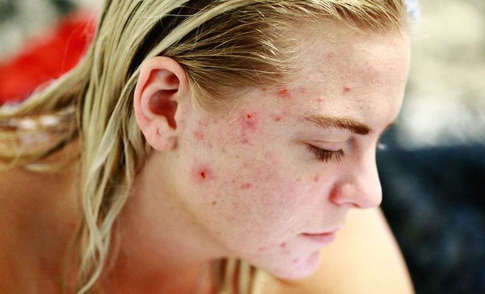 acne on your face