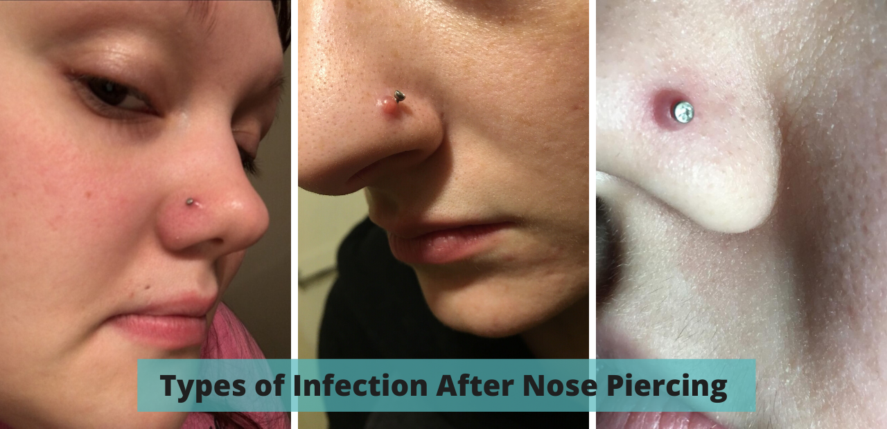 Types of Infection After Nose Piercing