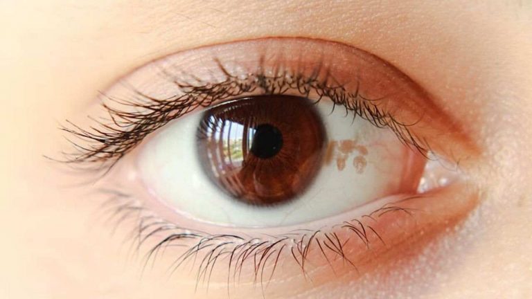 How to Get Rid of Brown Spots on White Part of Eye Naturally